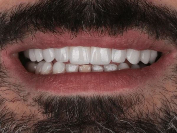 After crowns and bridges treatment