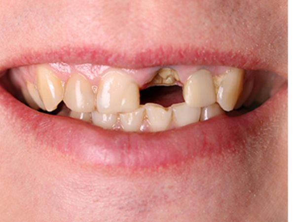 Before root canal treatment